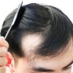 An Overview of Male Pattern Baldness: Causes, Symptoms, and Treatment Options