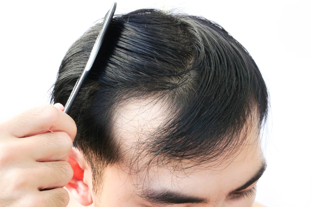 An Overview of Male Pattern Baldness: Causes, Symptoms, and Treatment Options